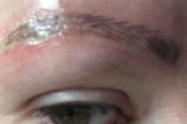 Article image for Melbourne salon sues for $150k after woman posts photos of eyebrow infection on Facebook