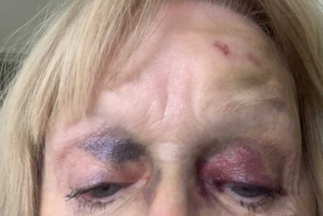 Article image for Family fumes over council response to elderly woman’s nasty fall